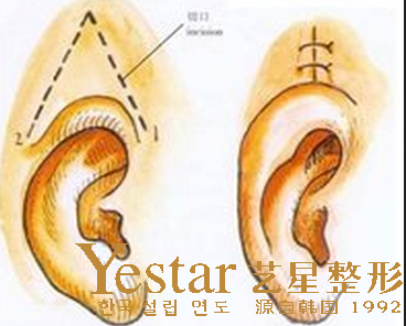 哪些人不適合做隱耳整形手術(shù)