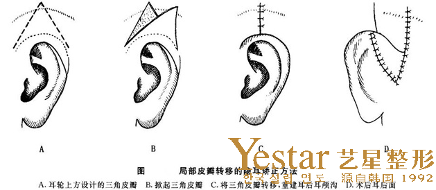 隱耳是什么樣的？隱耳癥能治嗎？