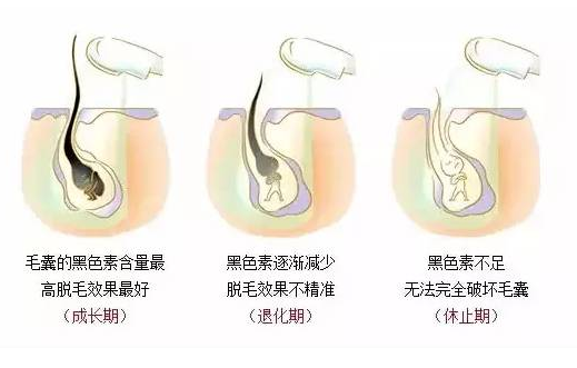 激光脫毛會(huì)有副作用嗎