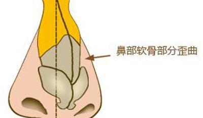 發(fā)生歪鼻有哪些原因