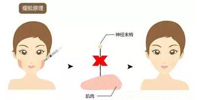 瘦臉后會(huì)咬肌無力嗎