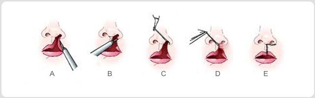 唇裂整形方法有哪些