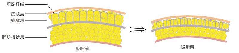 面部吸脂優(yōu)點(diǎn)有哪些