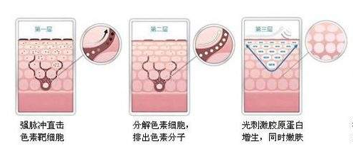 武漢祛斑用像素激光好嗎