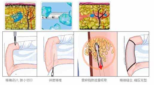 武漢腰腹部吸脂后皮膚會(huì)松弛嗎?