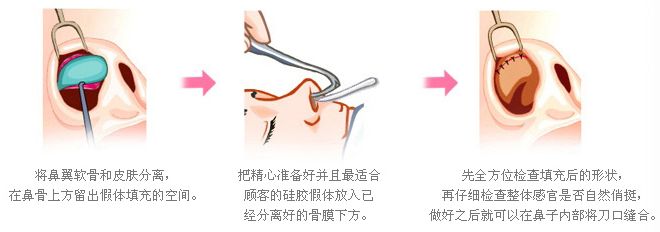 武漢隆鼻手術(shù)需要多久?