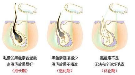 武漢冰點(diǎn)脫毛嗎?