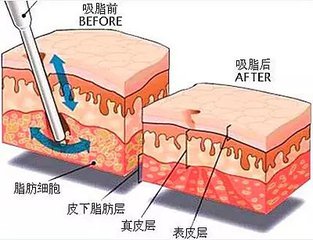 背部厚實(shí)可以做吸脂嗎?