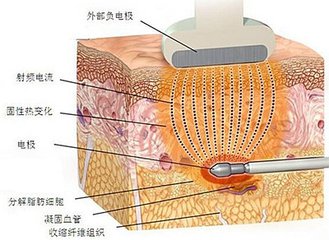 武漢背部吸脂的效果怎么樣?