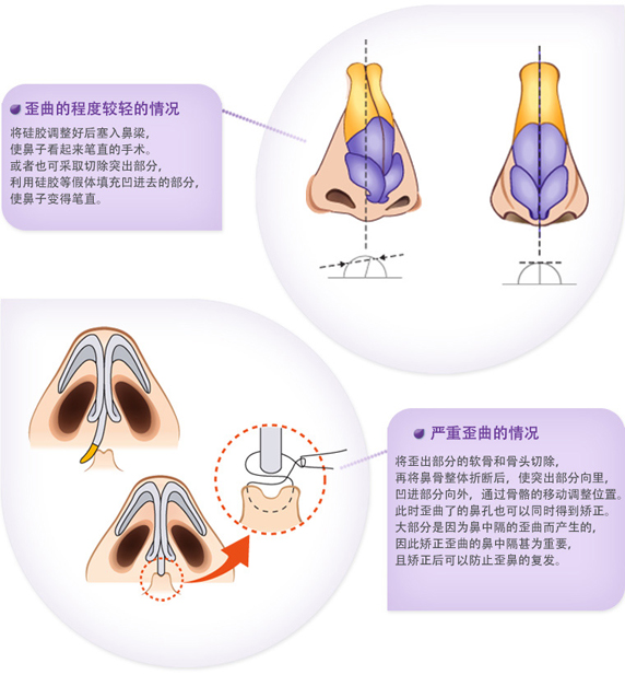 武漢歪鼻矯正整形的價格貴不貴