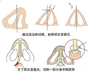 武漢是怎么做歪鼻矯正的?