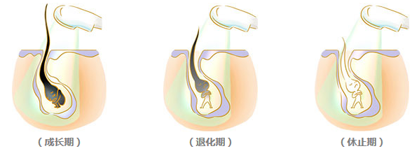 藝星激光脫毛多少錢?