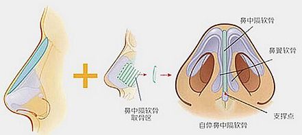 武漢韓式隆鼻如何快速消腫?