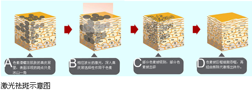 武漢老年斑怎么去