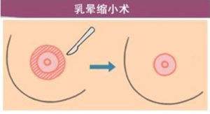 武漢乳暈縮小手術(shù)會(huì)不會(huì)有疤