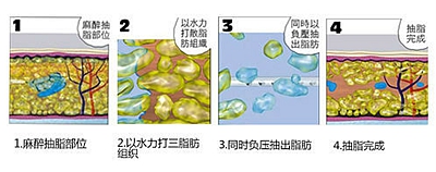 武漢水動力吸脂減肥后還會反彈嗎?