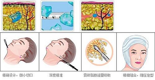 武漢雙下巴吸脂需要多長時間?