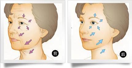 武漢哪些皺紋可以用電波拉皮除皺