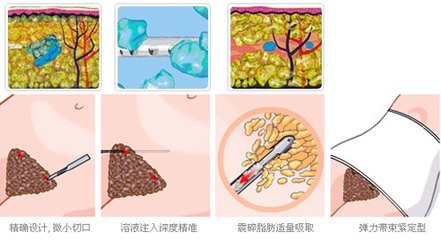 武漢做腰腹吸脂手術(shù)有沒有后遺癥?