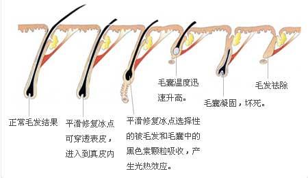 武漢冰點脫毛一般需要多久