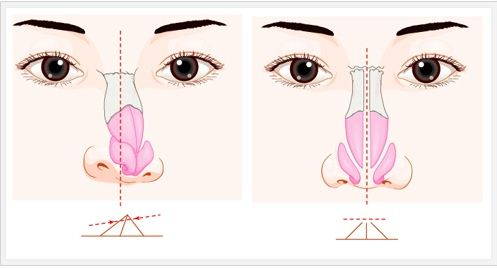 武漢歪鼻矯正手術(shù)方法是什么