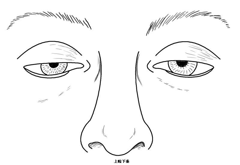 武漢治療上瞼下垂有什么方案