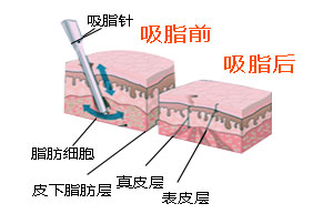 武漢背部吸脂效果好嗎