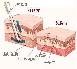 武漢做臀部吸脂哪家好