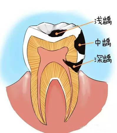 武漢怎么補(bǔ)牙