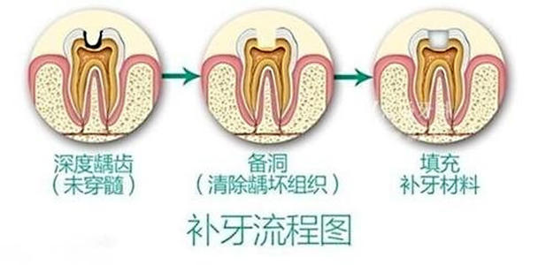 武漢補(bǔ)牙多少錢