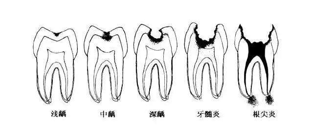 武漢補牙為什么要趁早