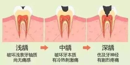 武漢補牙為什么要趁早