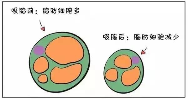 武漢腰腹吸脂有什么好處