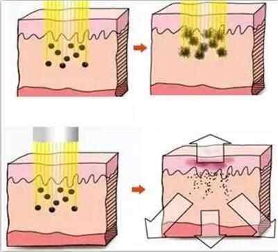 武漢激光祛雀斑是什么原理